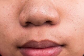 How To Remove Blackheads From Nose At Home