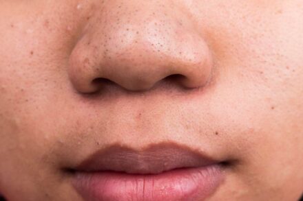 How To Remove Blackheads From Nose At Home