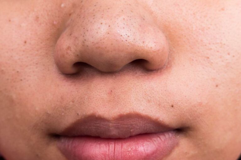 How To Remove Blackheads From Nose At Home