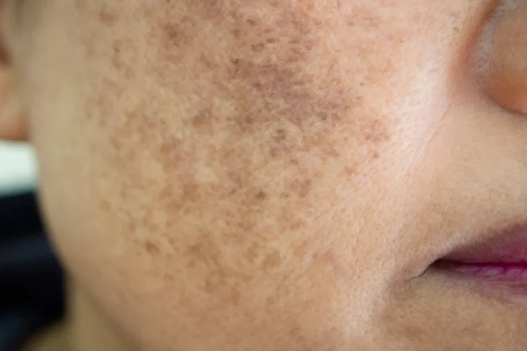 Why Dark Spots Look Worse in Summer and What You Can Do About It
