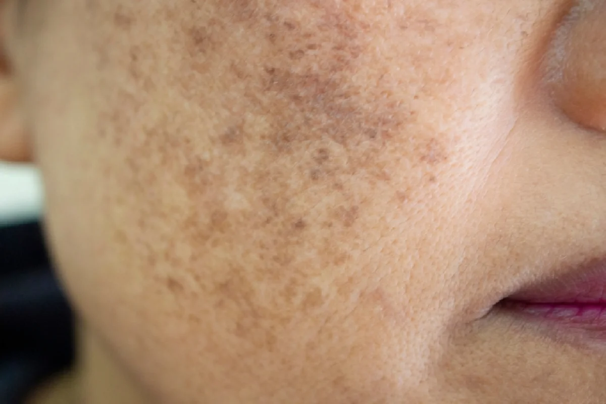 Why Dark Spots Look Worse in Summer and What You Can Do About It